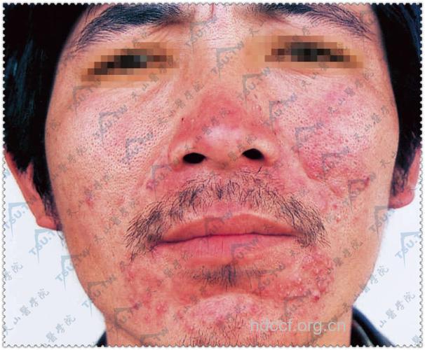 人体蠕形螨的感染现状