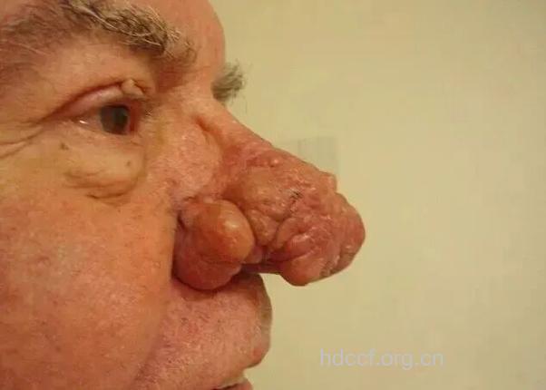 酒渣鼻是怎样得的？