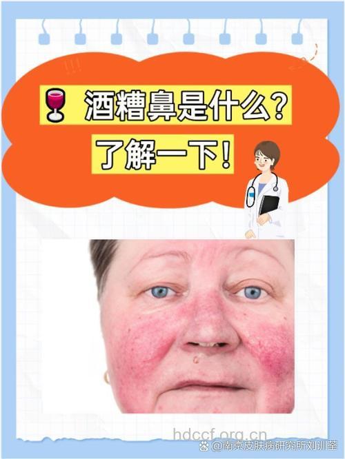 患酒糟鼻病因 一定是酗酒吗
