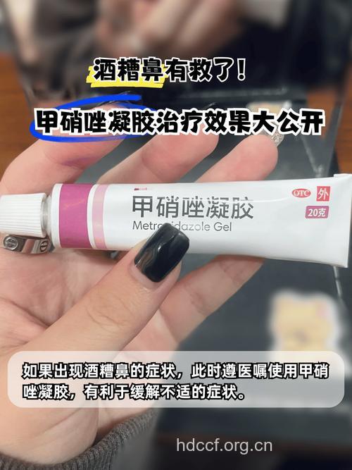 治疗酒糟鼻的药都是有什么