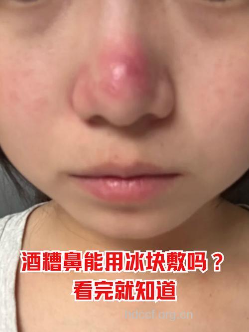 酒渣鼻的红斑是怎么回事