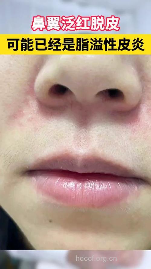 鼻子易得哪些皮肤病