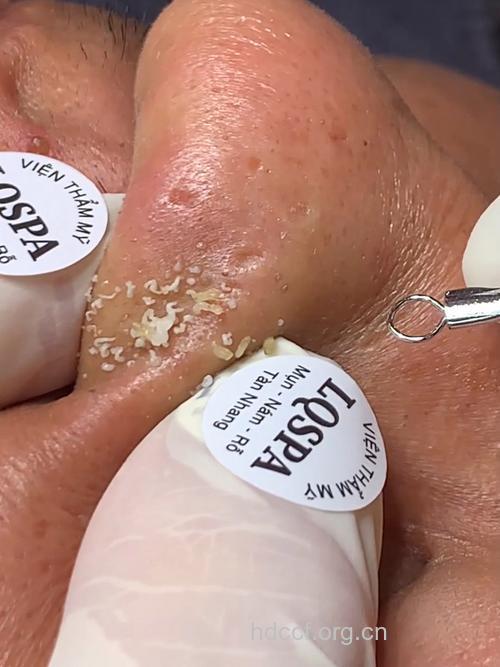 经常“挤黑头”挤成酒渣鼻