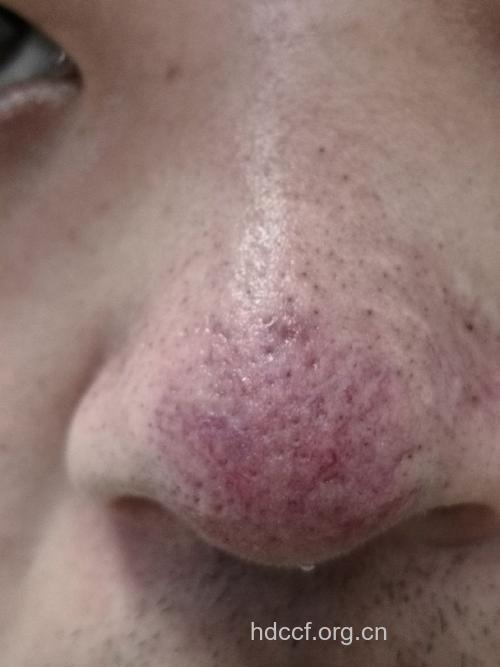 酒糟鼻有哪些典型症状
