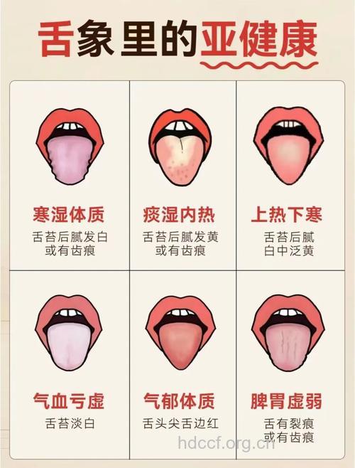 糖尿病患者应注意舌头的颜色