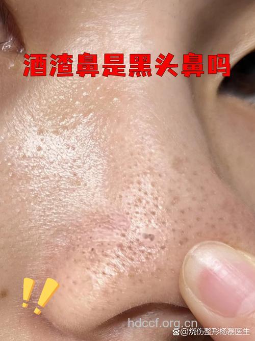 研究表明酒渣鼻可能与年龄有关