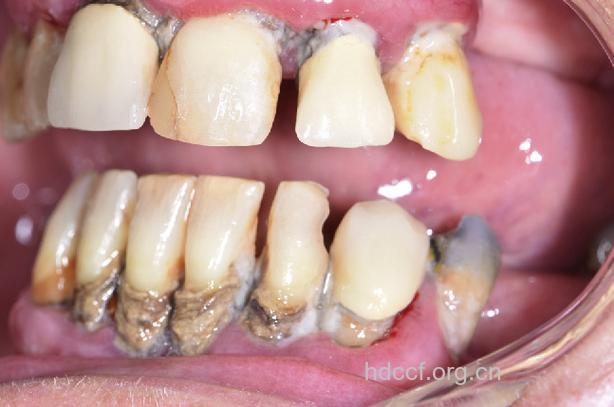 糖尿病人易患哪些口腔疾病