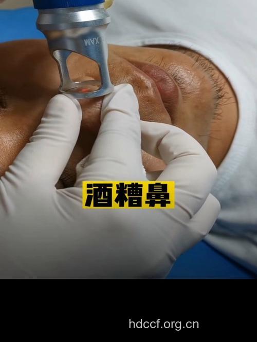 治疗酒渣鼻 首选激光疗法