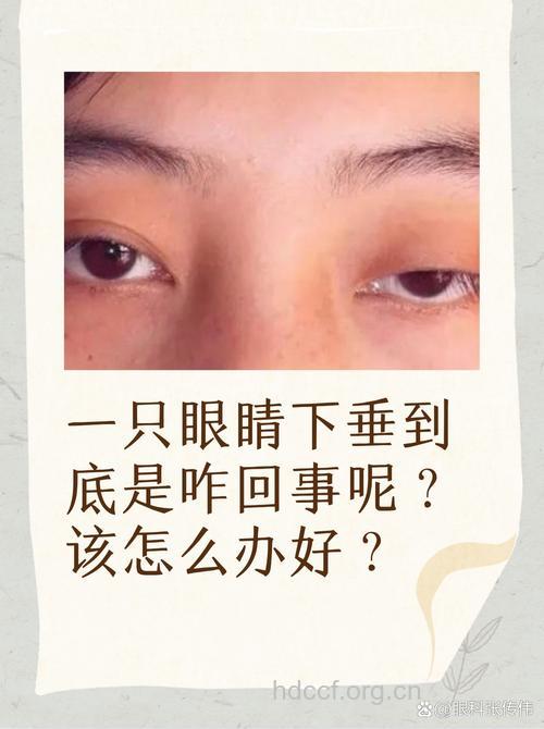 眼睑下垂是糖尿病先兆吗