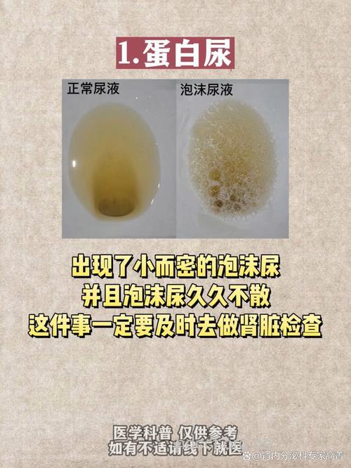 糖尿病患者的尿液特征