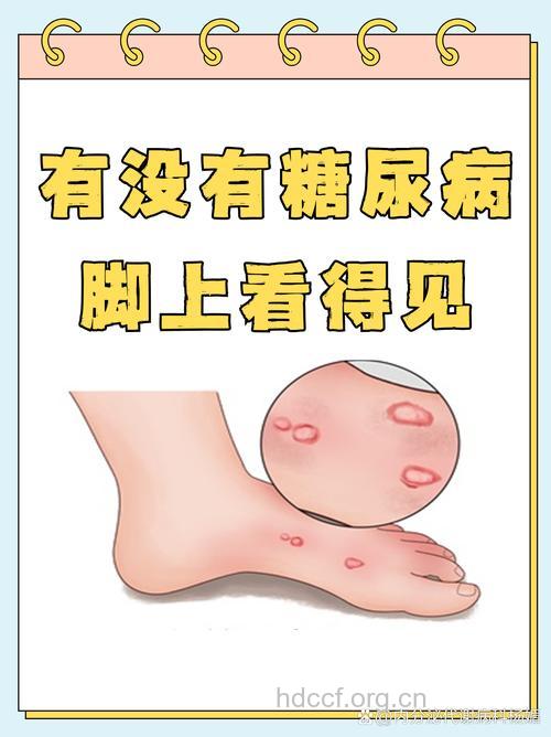糖尿病有哪些蛛丝马迹
