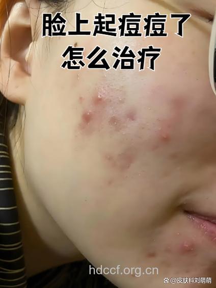 青春痘反复化脓注意血糖