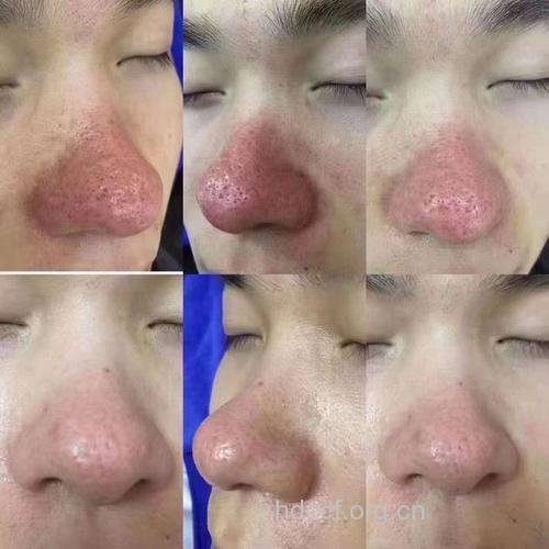 不可不知的酒渣鼻“三”时期
