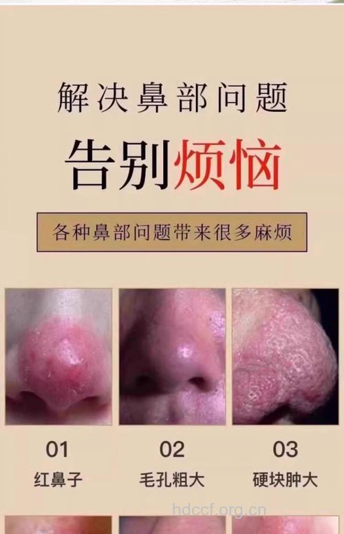 治疗轻微酒糟鼻 除螨最显效