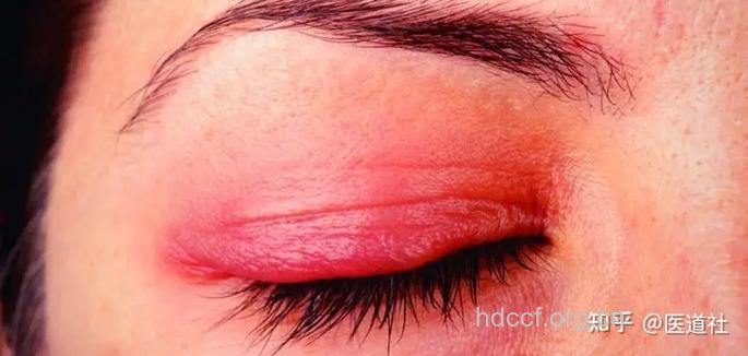 惊！眼睑也会患“酒渣鼻”