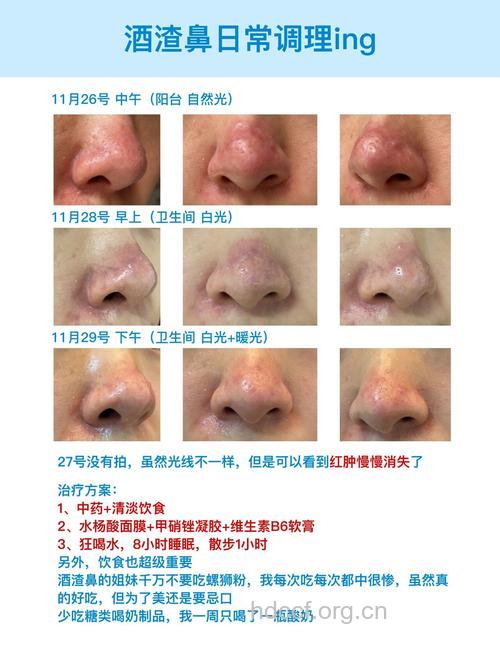 酒渣鼻是什么和治疗方法