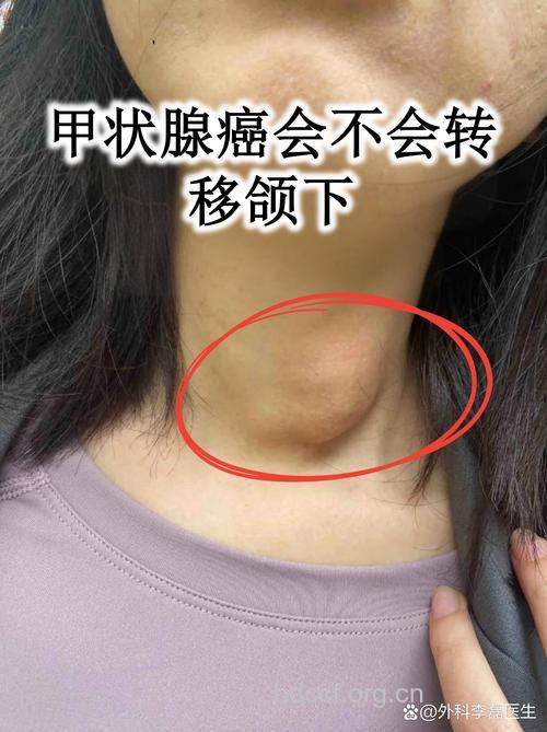 甲状腺癌是一种高发癌