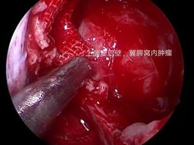 鼻咽纤维瘤血管瘤的症状有哪些