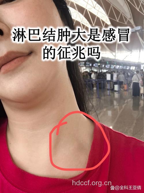 感冒可引起淋巴癌