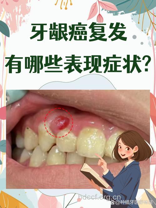 长期慢性刺激可导致牙龈癌