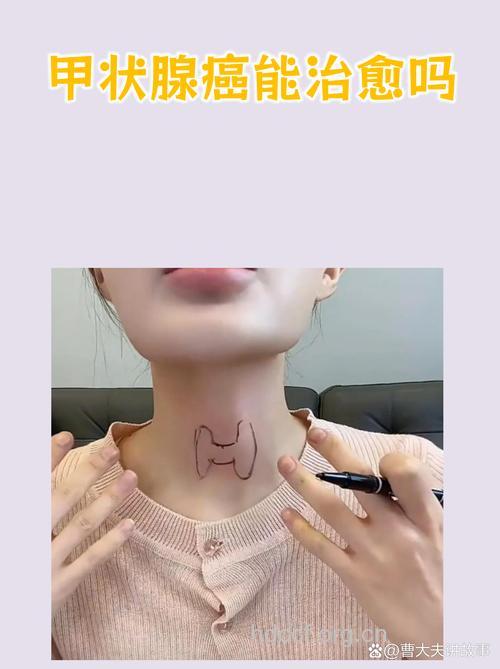 95%甲状腺癌患者是可以治愈的