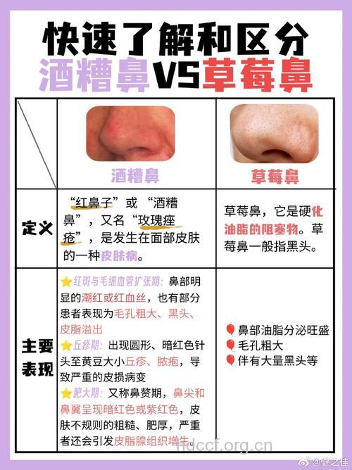 盘点:易与酒渣鼻混淆的疾病