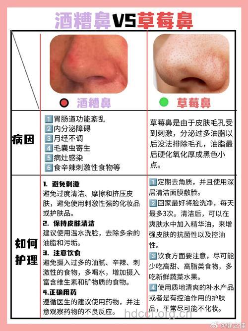 轻微酒糟鼻 除螨是关键
