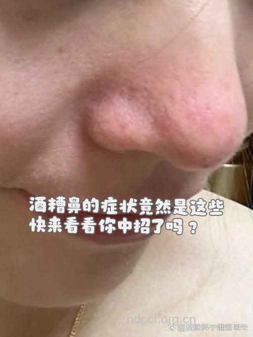 酒渣鼻让你失掉信心吗？