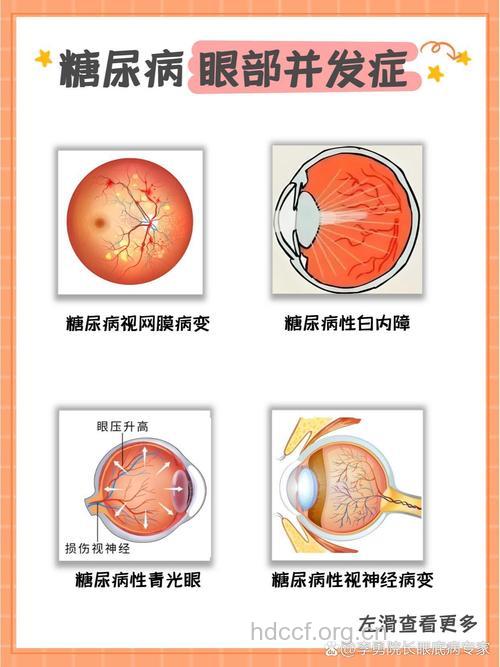瞳孔变小是患糖尿病了吗