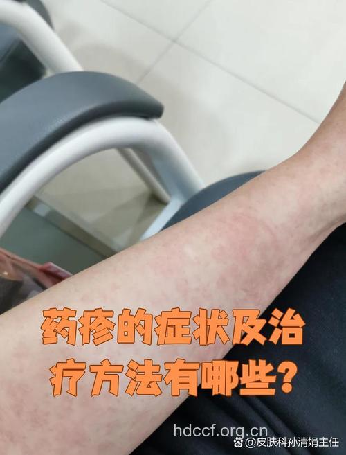 药物性皮炎的类型及临床表现