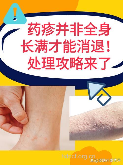 药物性皮炎是怎么形成的