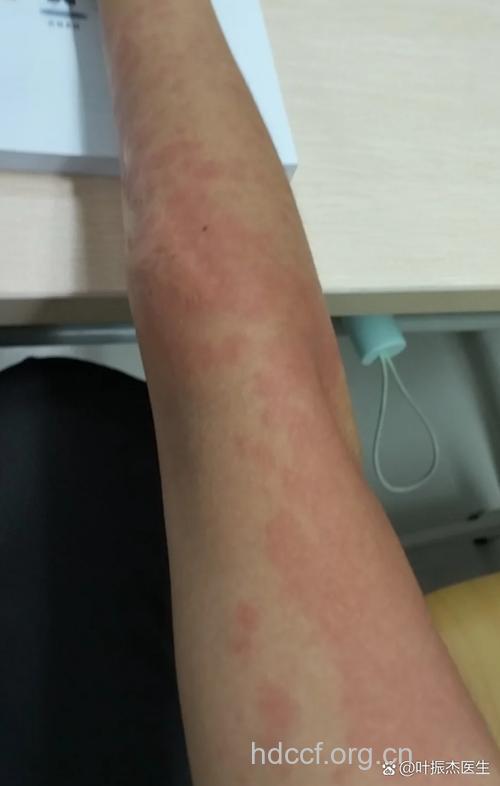 联合疗法治疗麻疹样红斑