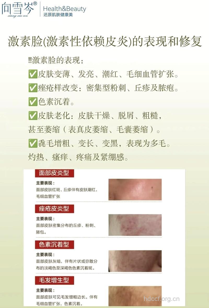 激素依赖性皮炎如何处理