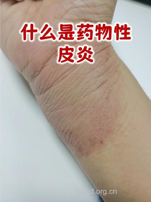 药物性皮炎是怎么发生的