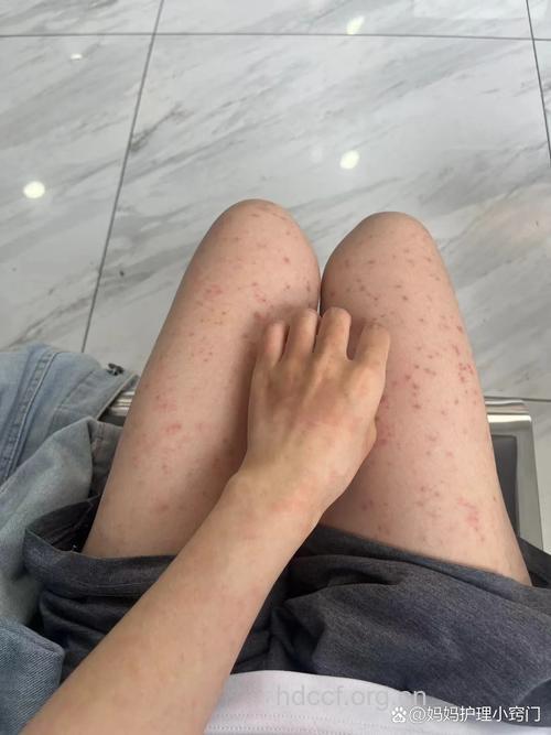 乱搽药 皮肤过敏找上你！