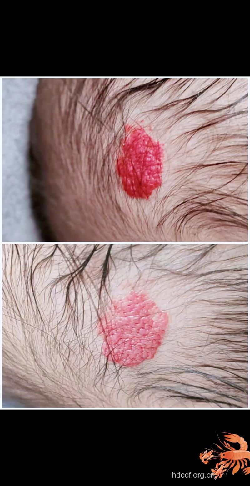 草莓血管瘤的治疗方法有哪些