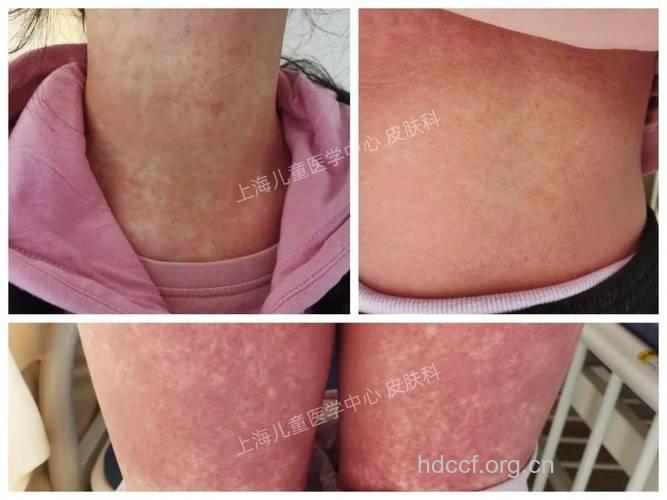 小心药疹缠上你