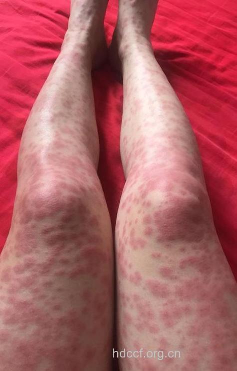 药物性皮炎有哪些表现形态?