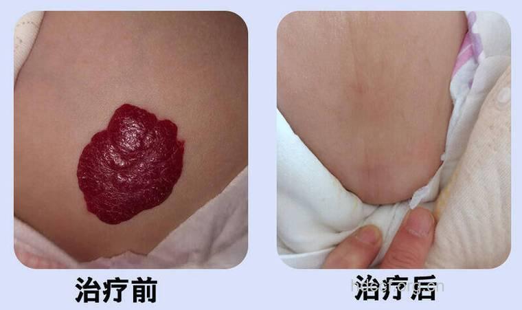 骨血管瘤的症状表现有哪些