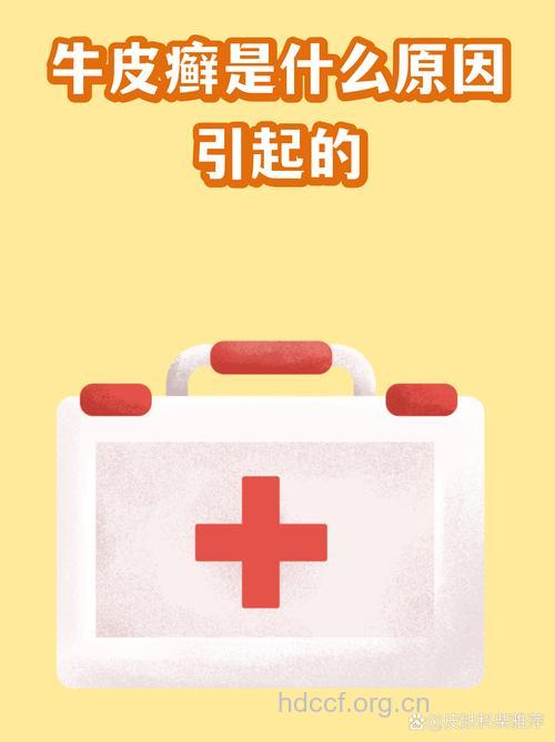 牛皮癣具体的发病原因