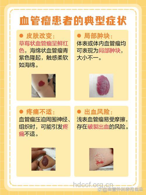 血管瘤到底有多大危害