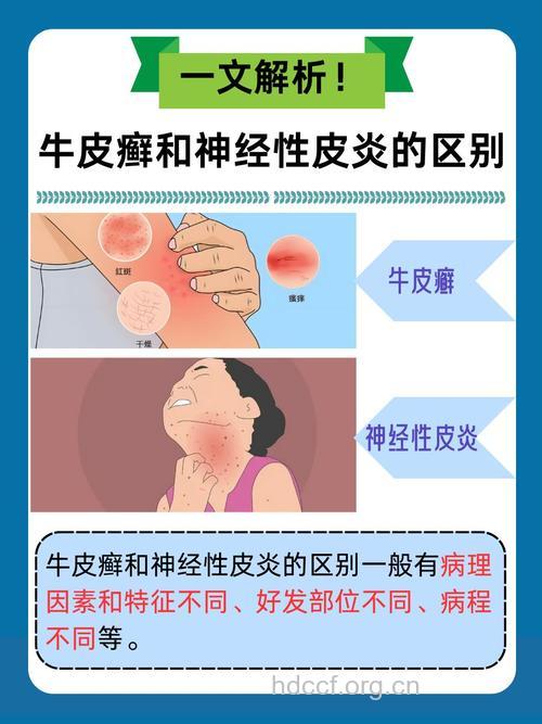 神经性皮炎和银屑病有什么区别