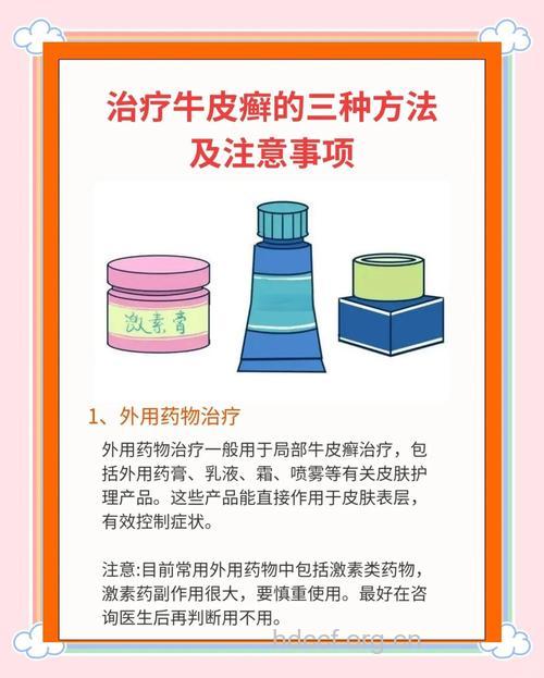 寻常型银屑病的治疗方法