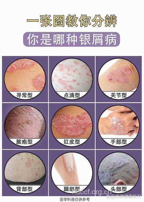 牛皮癣是哪种类型的疾病呢