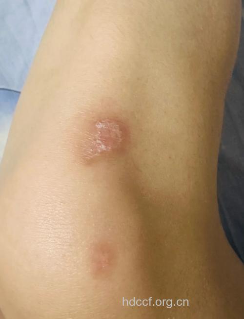 冬季牛皮癣长期不愈危害大