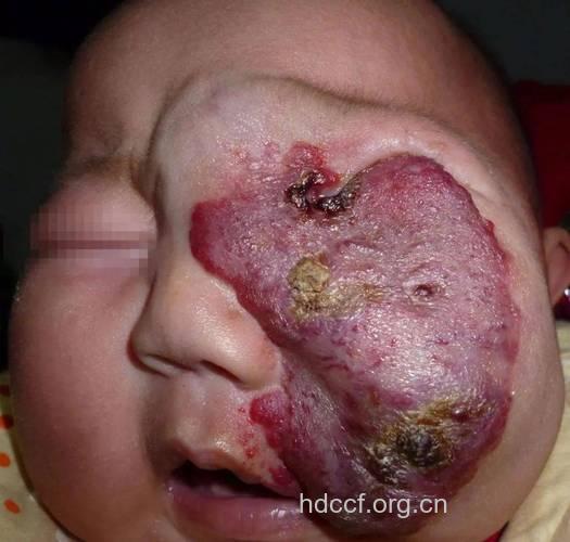 面部血管瘤有哪些常见类型