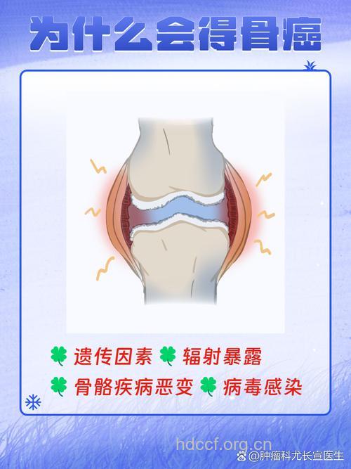 会诱发骨癌的因素有哪些