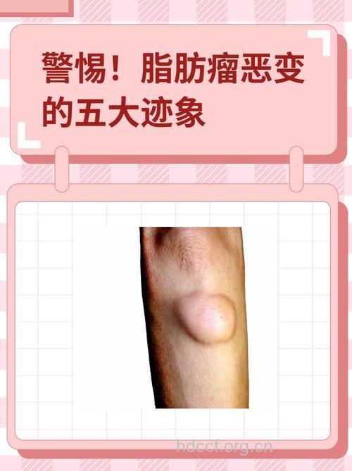 脂肪瘤会癌变吗