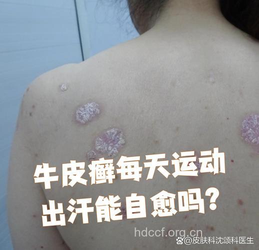 科学洗澡牛皮癣好得快 专家建议多出汗