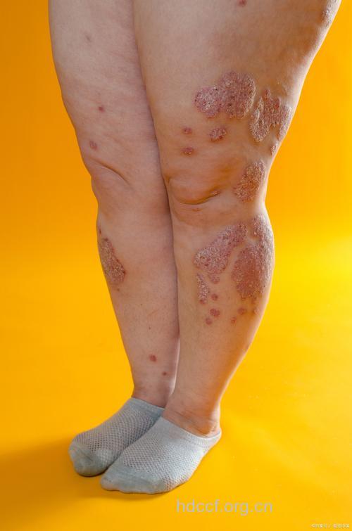 微生物感染也可导致牛皮癣